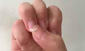 Dấu hiệu cơ thể thiếu vitamin, khoáng chất